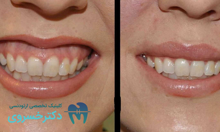 مزایا و معایب درمان لبخند لثه ای
