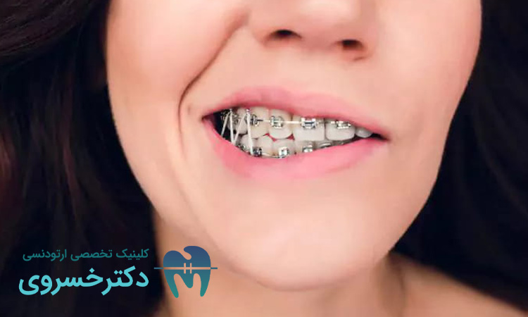 مزایای کشیدن دندان در ارتودنسی