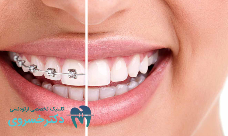 مزایای ارتودنسی در سن بالا