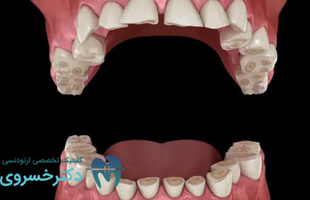 علائم و عوارض دندان قروچه