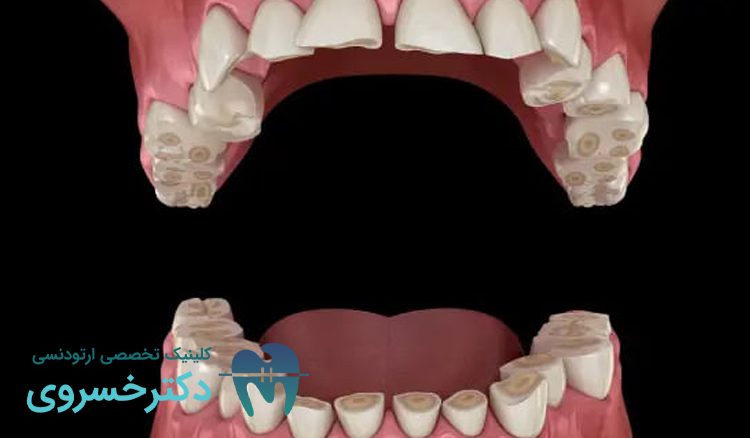 علائم و عوارض دندان قروچه