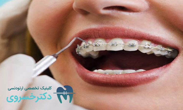 نشانه های رایج نشان دهنده نیاز به ارتودنسی مجدد