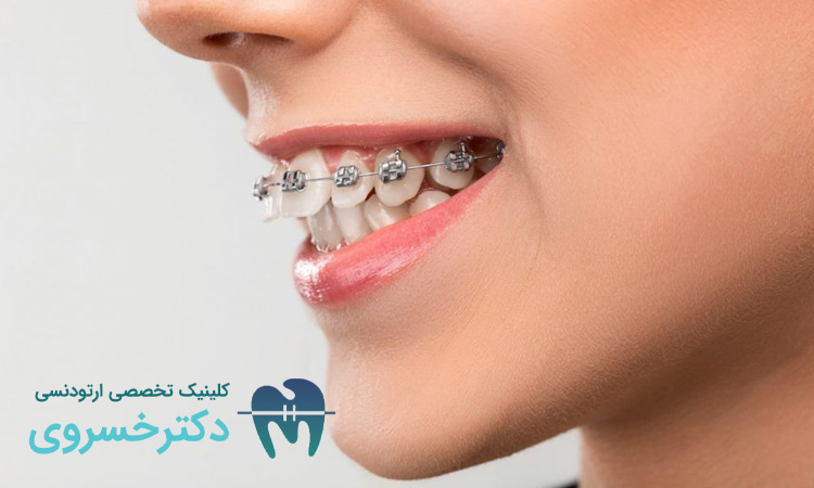 هزینه ارتودنسی با بیمه تکمیلی