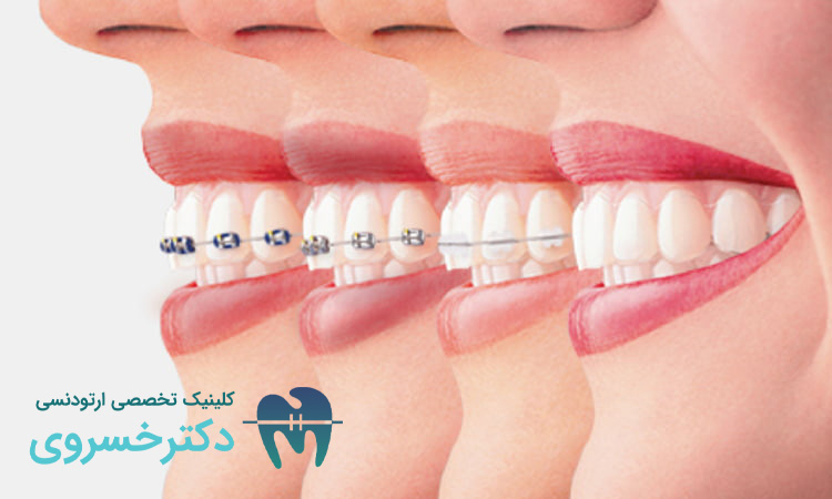 تصور غلط درباره ارتودنسی در سن بالا مؤثر