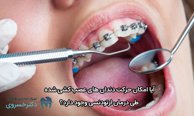 حرکت دندان های عصب کشی شده طی درمان ارتودنسی