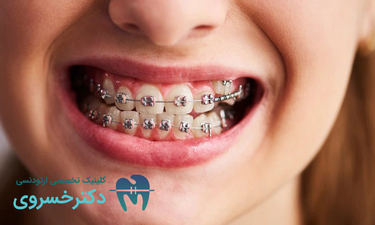 تفاوت لق شدن طبیعی و لق شدن در طول ارتودنسی