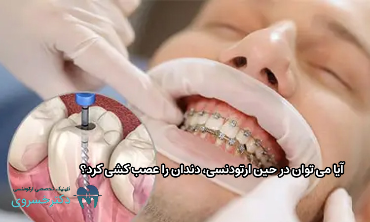 آیا می توان در حین ارتودنسی، دندان را عصب کشی کرد؟