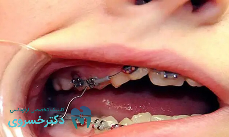 اثر مصرف نوشیدنی الکلی بر اجزای ارتودنسی