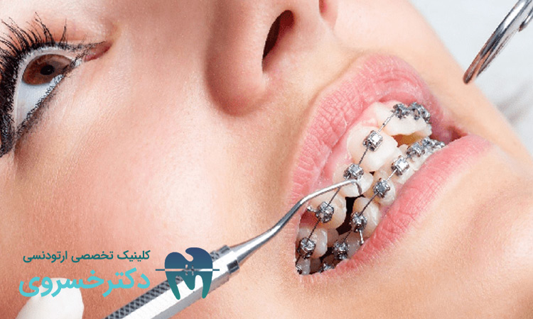 لق شدن دندان ها با ارتودنسی