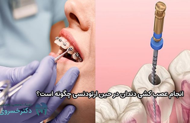 انجام عصب کشی دندان در حین ارتودنسی