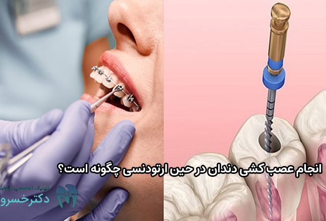 انجام عصب کشی دندان در حین ارتودنسی