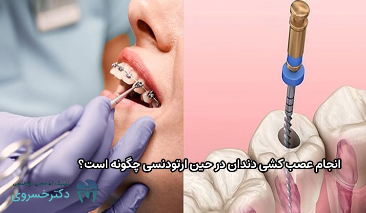 انجام عصب کشی دندان در حین ارتودنسی
