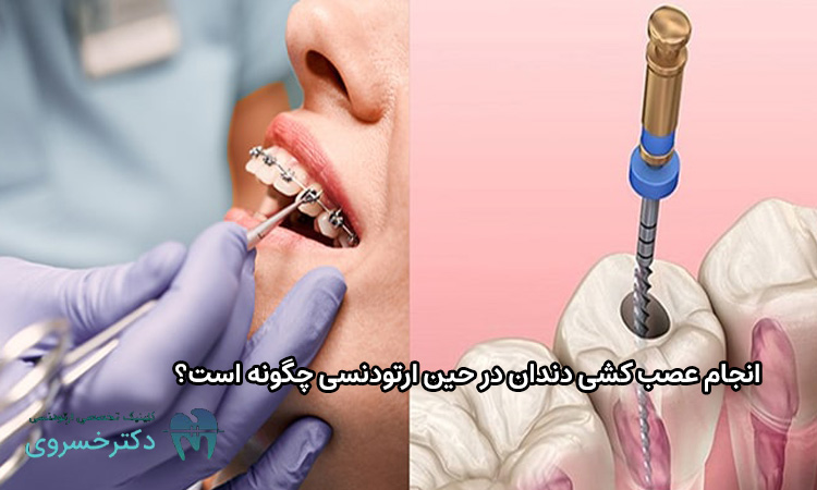 انجام عصب کشی دندان در حین ارتودنسی