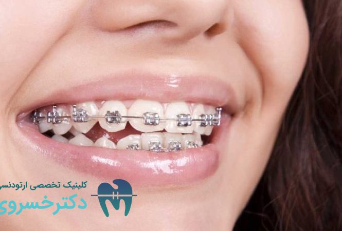 انواع سیم ارتودنسی