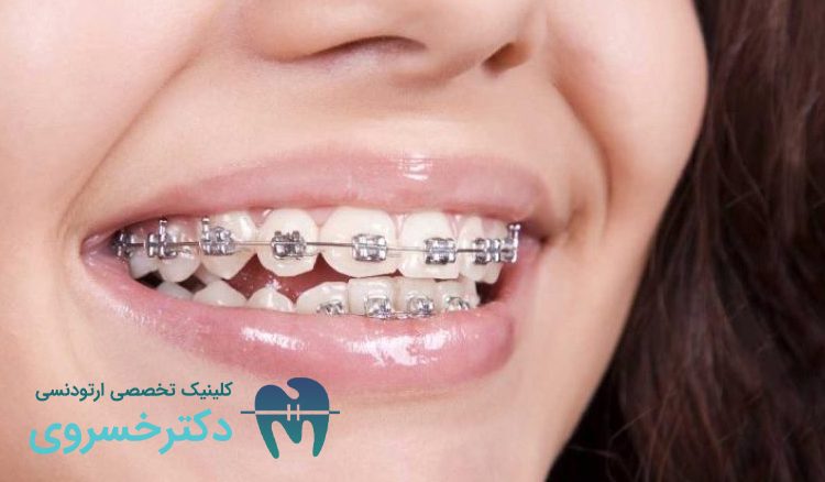 انواع سیم ارتودنسی