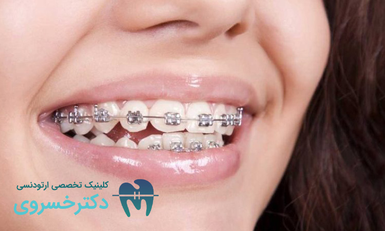 انواع سیم ارتودنسی