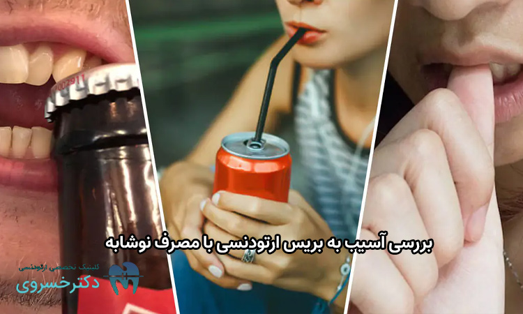 آسیب به بریس ارتودنسی با مصرف نوشابه.