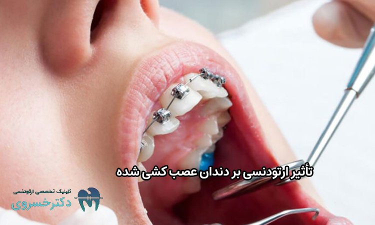 تأثیر ارتودنسی بر دندان عصب کشی شده