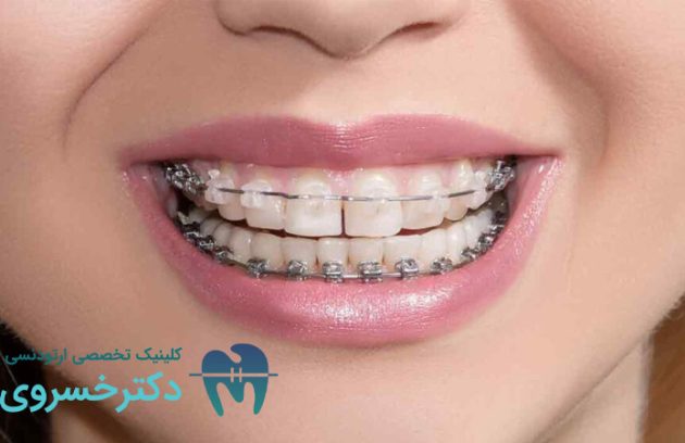 تأثیر نوشیدنی الکلی بر درمان ارتودنسی