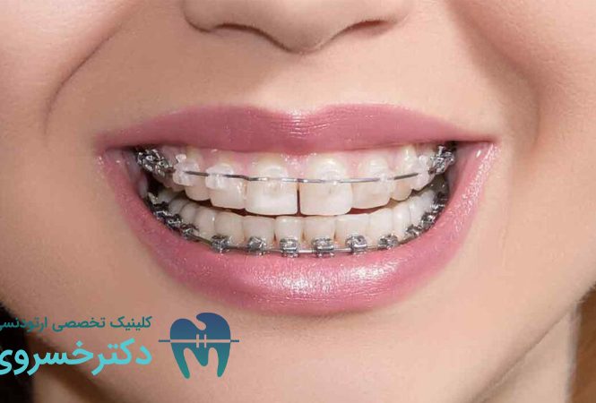 تأثیر نوشیدنی الکلی بر درمان ارتودنسی