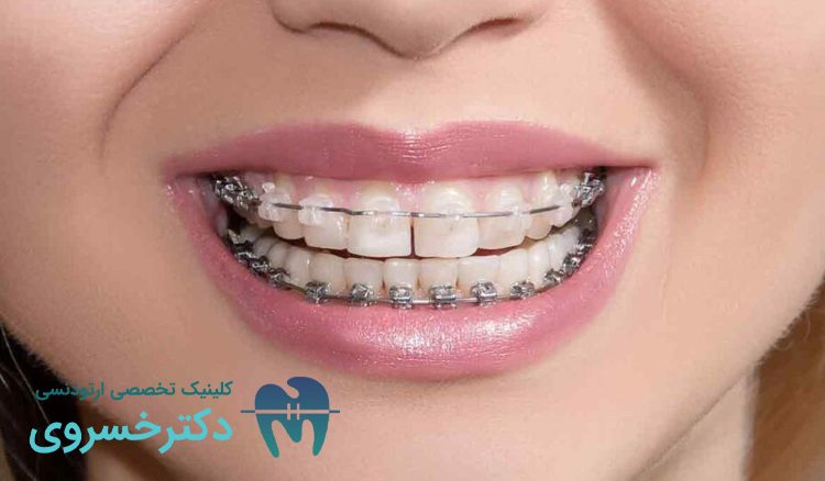 تأثیر نوشیدنی الکلی بر درمان ارتودنسی