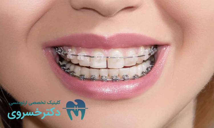 تأثیر نوشیدنی الکلی بر درمان ارتودنسی