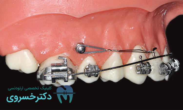 تداخل مصرف الکل با داروهای ارتودنسی