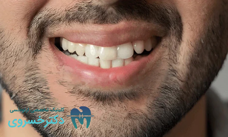 تشخیص انحراف میدلاین