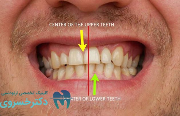 درمان انحراف میدلاین