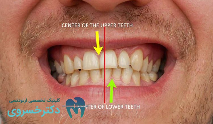 درمان انحراف میدلاین