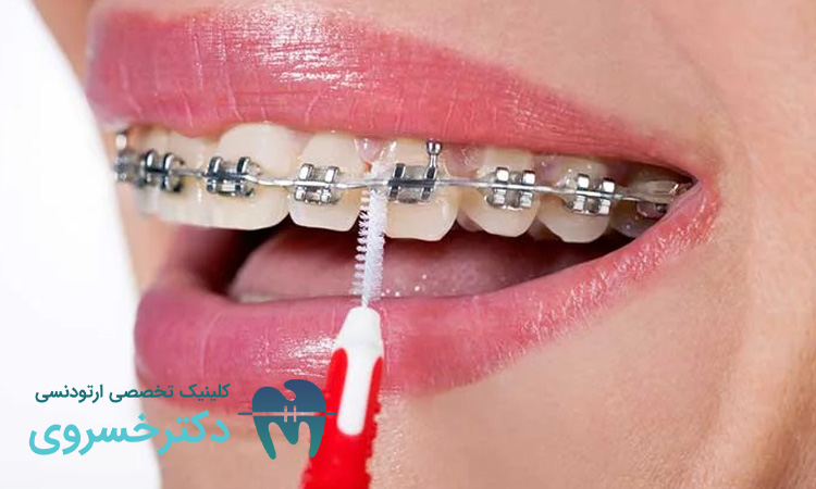 تاثیر الکل بر ارتودنسی