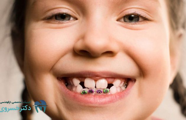 ارتودنسی تیکه‌ای