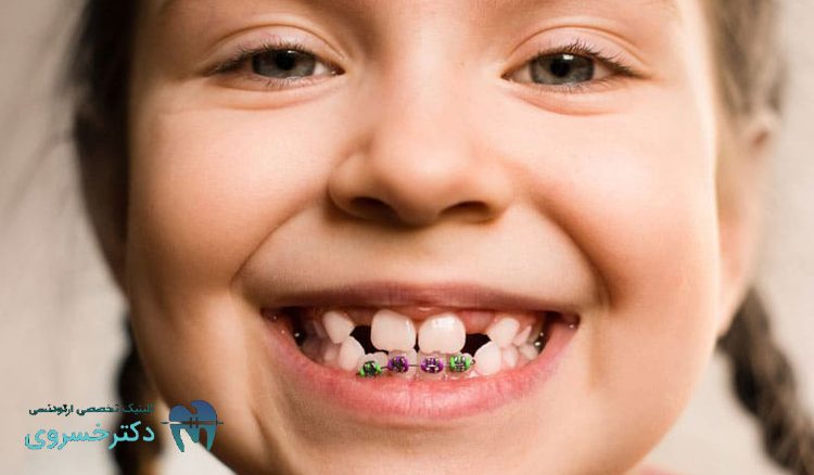 ارتودنسی تیکه‌ای