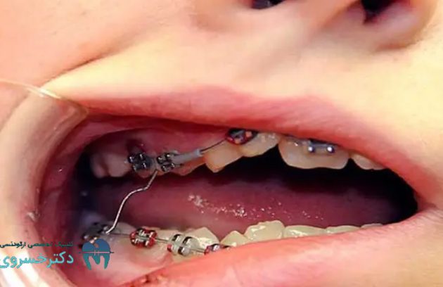 دلیل شکستگی دندان در ارتودنسی