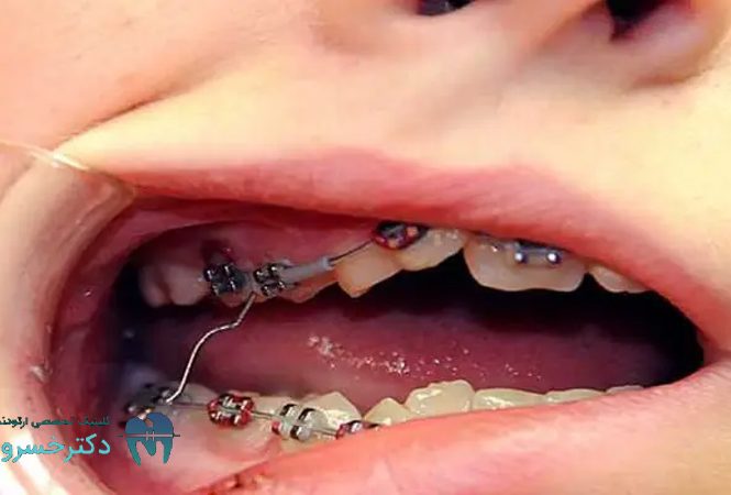 دلیل شکستگی دندان در ارتودنسی