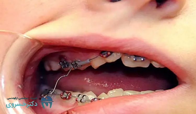 دلیل شکستگی دندان در ارتودنسی