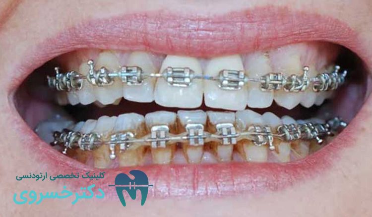پوسیدگی دندان با ارتودنسی