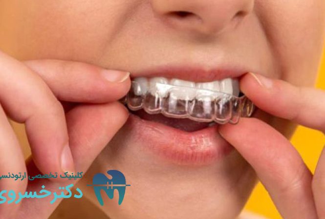 مناسب بودن ارتودنسی نامرئی برای کودکان