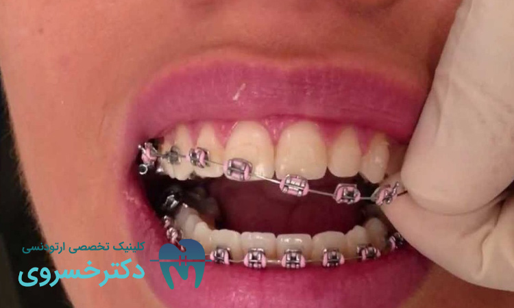 پوسیدگی دندان با بریسها