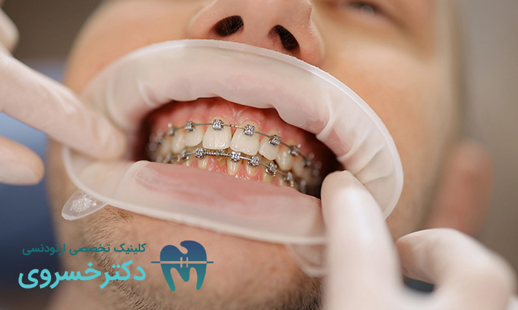 اثرات ارتودنسی بر بهبود کیفیت خواب