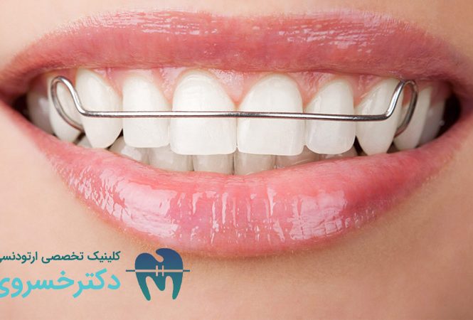 دندان هایی که ارتودنسی متحرک نیاز دارند