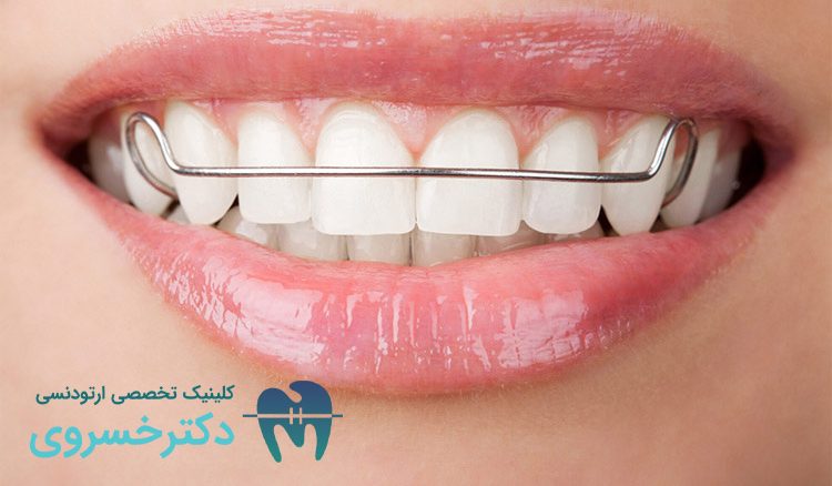 دندان هایی که ارتودنسی متحرک نیاز دارند