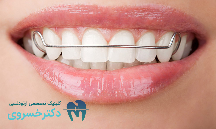 دندان هایی که ارتودنسی متحرک نیاز دارند