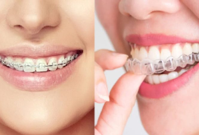 ارتودنسی نامرئی یا سیمی؟ کدام بهتر است؟
