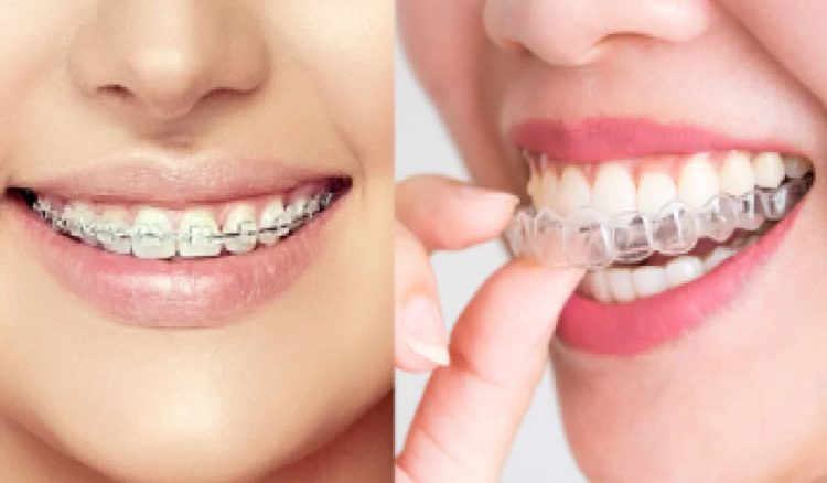 ارتودنسی نامرئی یا سیمی؟ کدام بهتر است؟