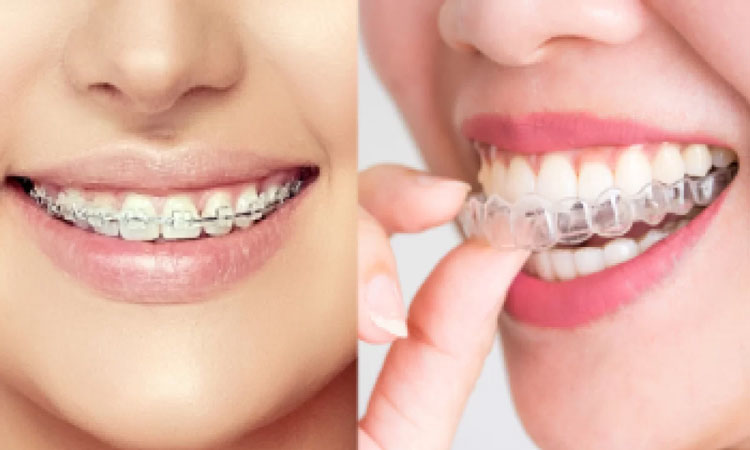 ارتودنسی نامرئی یا سیمی؟ کدام بهتر است؟