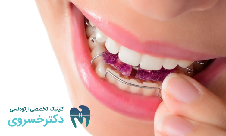 انواع نگهدارندههای متحرک بعد از ارتودنسی