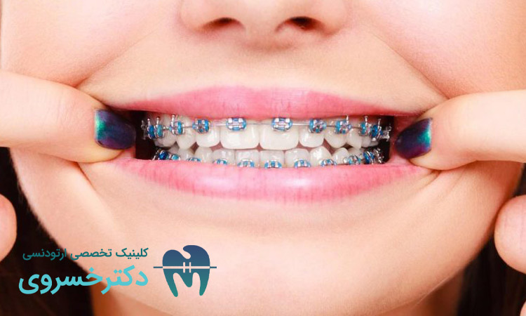 بررسی خرابی دندان ها با ارتودنسی