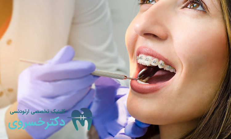 تأثیر نوع براکت و روش ارتودنسی بر سلامت دندان ها