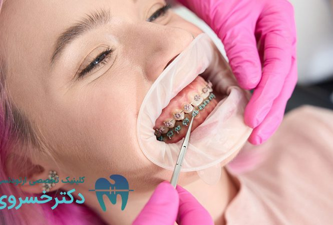 زمان لازم جلسه اول ارتودنسی
